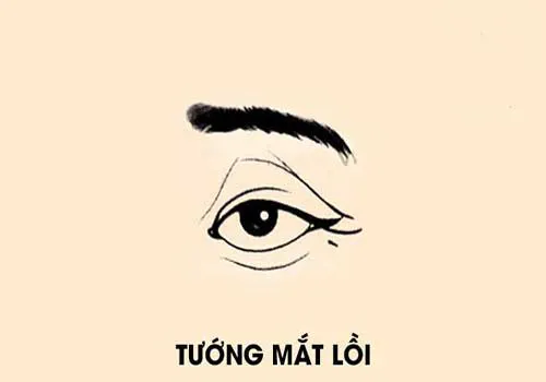 Mắt lồi: Nguyên nhân, triệu chứng & Cách chữa trị/Phòng tránh