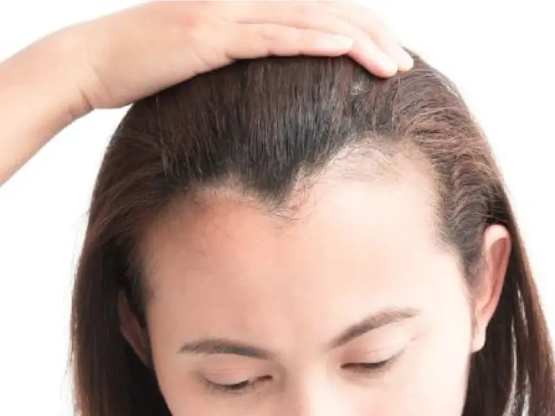 Đường chân tóc nhân tướng: Chân tóc chữ M, thẳng và hình tim nói gì về vận trí trẻ