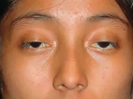 Mắt lờ đờ: Nguyên nhân, ý nghĩa nhân tướng và phân biệt bệnh lý