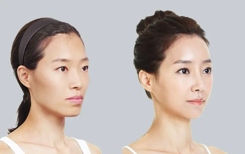 Phân tích ảnh tiêm filler gò má thay đổi tướng trên khuôn mặt