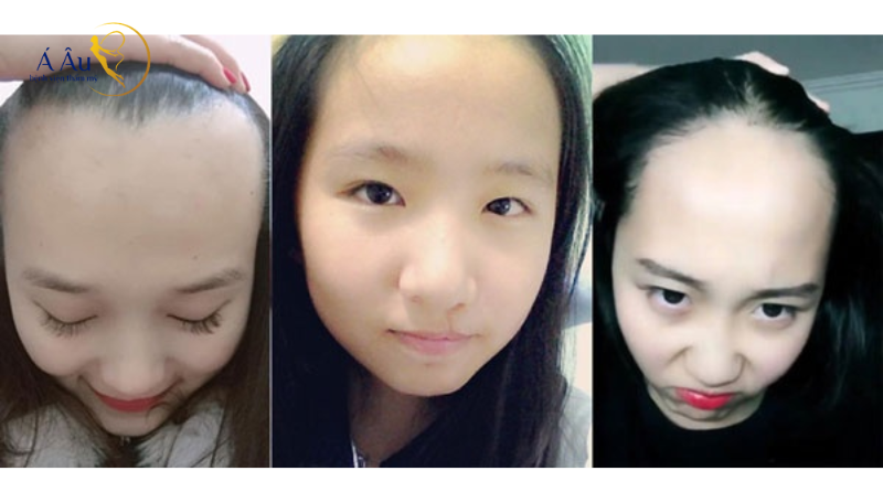 Trán dô là gì: xem tướng trán dô để hiểu tính cách, sự nghiệp và hôn nhân