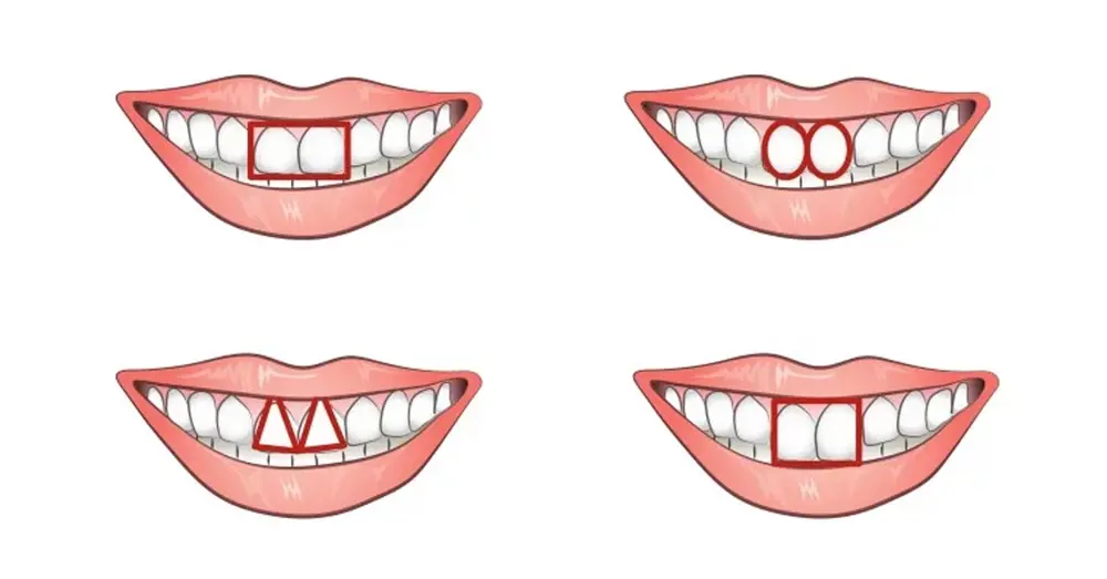 Tướng răng nhân tướng học: Giải mã răng đều, răng hô, răng thưa, răng khểnh
